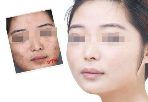 廣州肚皮上的妊娠紋如何有效修復(fù)？