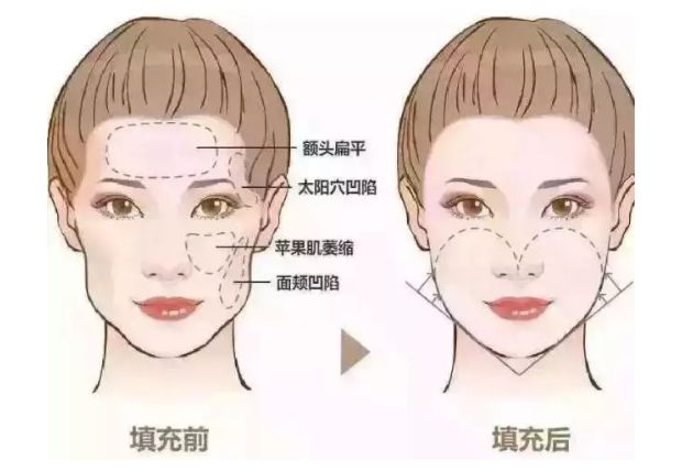 2024抗衰指南:權(quán)威機構(gòu)去皺項目效果測評 2024抗衰指南:權(quán)威機構(gòu)去皺項目效果測評