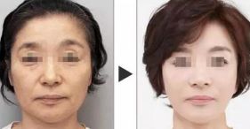 西安哪家醫(yī)院擅長面部輪廓整形？