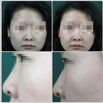 長春銘醫(yī)整形醫(yī)院雙眼皮手術(shù)效果及費(fèi)用查詢