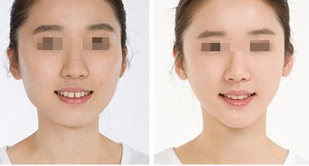 杭州治療鼻骨骨折的醫(yī)院推薦 杭州治療鼻骨骨折的醫(yī)院推薦