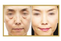 日照哪家醫(yī)院做雙眼皮手術技術高效？