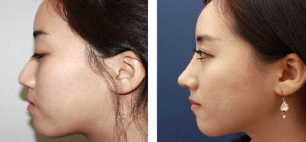 北京大腿抽脂專家推薦，哪個(gè)醫(yī)院技術(shù)好？
