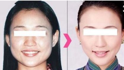 貴陽(yáng)哪家醫(yī)院做自體脂肪豐蘋(píng)果肌比較好 貴陽(yáng)哪家醫(yī)院做自體脂肪豐蘋(píng)果肌比較好