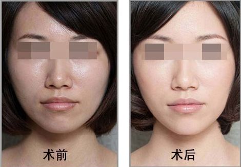 佛山哪家整形醫(yī)院是喬雅登個(gè)人推薦的Top7 佛山哪家整形醫(yī)院是喬雅登個(gè)人推薦的Top7