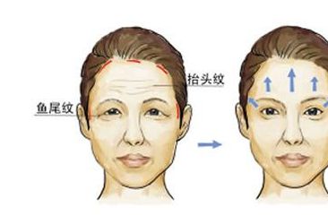 南京哪家醫(yī)院專業(yè)去痣效果好 南京哪家醫(yī)院專業(yè)去痣效果好