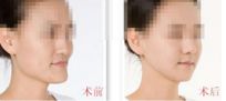 成都哪家醫(yī)院做自體豐胸效果更好？