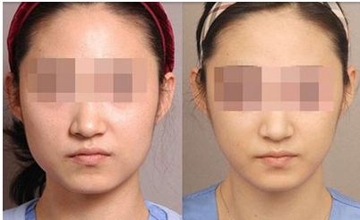 蘭州鼻子整形效果如何？