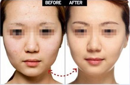 上海眼部整形醫(yī)院推薦，雙眼皮修復(fù)效果好