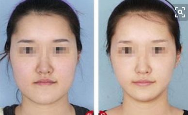 鄭州眼睛修復(fù)哪家醫(yī)院效果好 鄭州眼睛修復(fù)哪家醫(yī)院效果好
