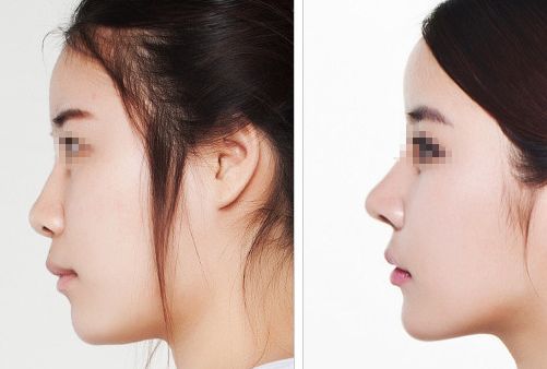 汕頭名流整形醫(yī)院：拉雙眼皮、吸脂價格一覽，專家解讀真實案例