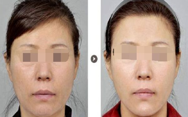 淄博專業(yè)去斑醫(yī)院推薦 淄博專業(yè)去斑醫(yī)院推薦