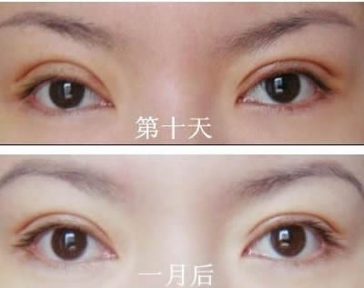 洛陽額頭打除皺針醫(yī)生