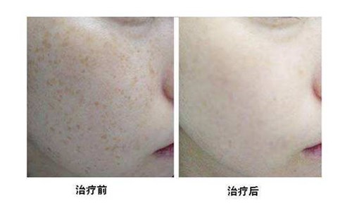 大連生長(zhǎng)紋線雕醫(yī)生