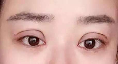 南京面部皺紋手術剝離醫(yī)生
