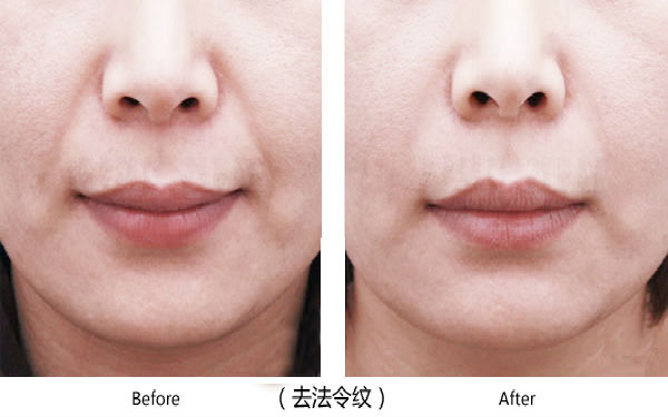 寶雞整容醫(yī)院大整頂級(jí)優(yōu)質(zhì)匯總！高一生對(duì)決愛(ài)容妍_絕對(duì)實(shí)力的對(duì)比震撼
