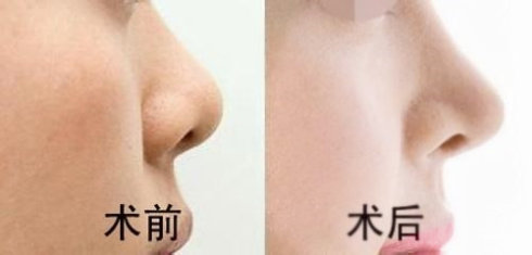 重慶現(xiàn)在有哪些當(dāng)代鼻子整形醫(yī)生值得關(guān)注？參考謝錦清和曾高醫(yī)生的口碑評(píng)價(jià)
