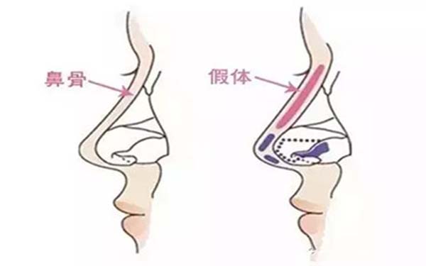 成都肋軟骨隆鼻醫(yī)生