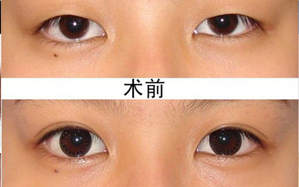 2023西安鼻基骨縮窄手術(shù)醫(yī)院排名前10強(qiáng)，值得信賴的口碑推薦！