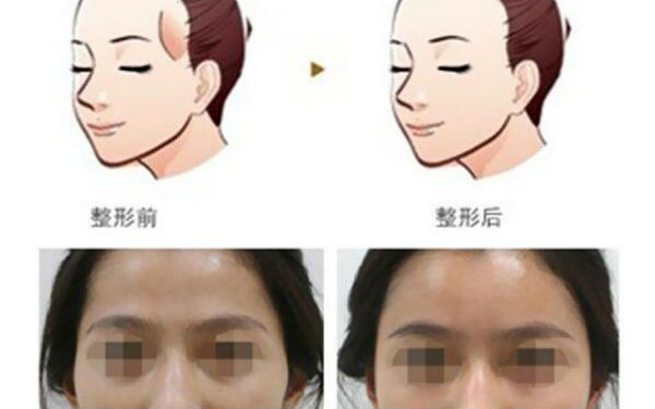 洛陽哪家醫(yī)院做木偶紋效果好？2023榜單出爐，洛陽物理去木偶紋top10佳選露面！