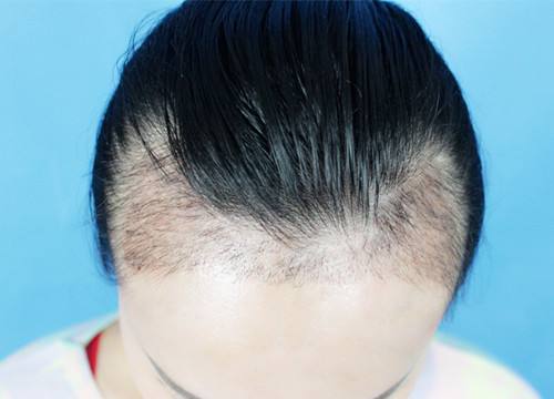 宜賓市哪家整形醫(yī)院專業(yè)豐額頭術(shù)效果好？探尋宜賓自體脂肪豐額頭術(shù)醫(yī)院口碑佳！2023宜賓豐額頭術(shù)推薦前十技