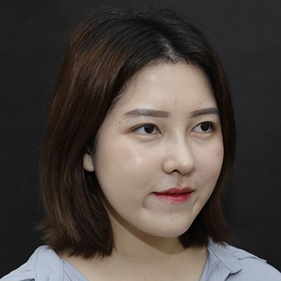 廣州美恩半肋鼻手術(shù)恢復(fù)效果反饋，主任親自操刀的效果就是贊！