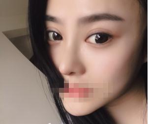 重慶星范整形超體隆鼻一個月效果