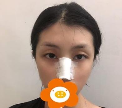 溫州韓美周杰群醫(yī)生耳軟骨隆鼻案例分享術后即刻