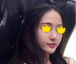 塌鼻子小妹在深圳鵬愛(ài)做隆鼻手術(shù)，三個(gè)月后竟然是這樣的