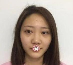 北京彤美耳軟骨隆鼻三個月效果分享，吐血推薦