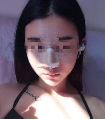石家莊諾萬(wàn)整形姚華榮硅膠隆鼻案例分享術(shù)后兩天效果