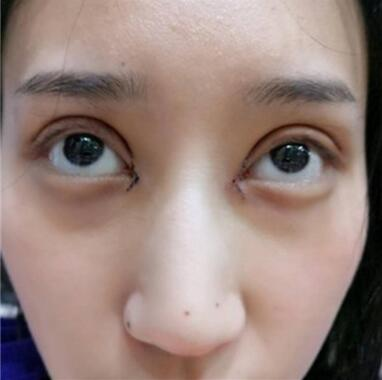雙眼皮失敗丑的不敢見(jiàn)人，昆明麗都整形雙眼皮修復(fù)案例分享