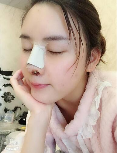 北京哪家隆鼻好？花一萬鼻子做成這樣值不值