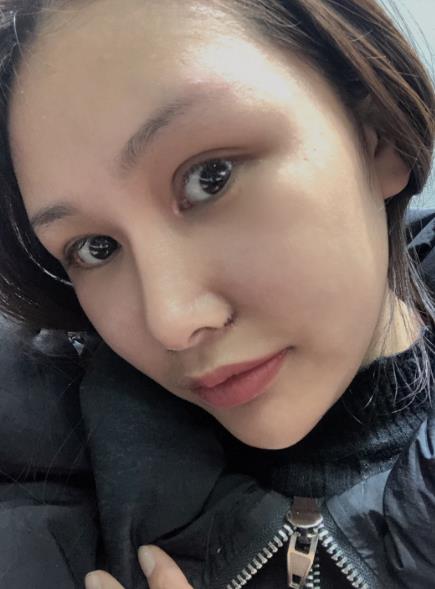 長春中研整形黃帝云鼻頭縮小案例術(shù)后一個(gè)月效果