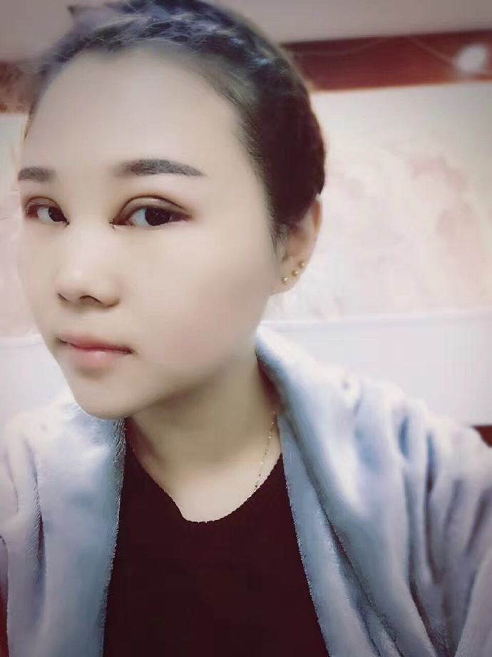 腫眼泡應(yīng)該做哪種雙眼皮？汕頭曙光雙眼皮三個月效果分享