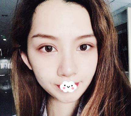 武漢伊萊美割雙眼皮案例分享術(shù)后半個(gè)月效果