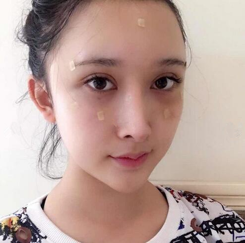 深圳陽光全臉填充術后即刻效果