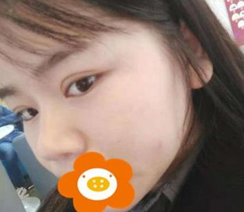 據(jù)說杭州薇琳隆鼻后效果很自然，有案例嗎