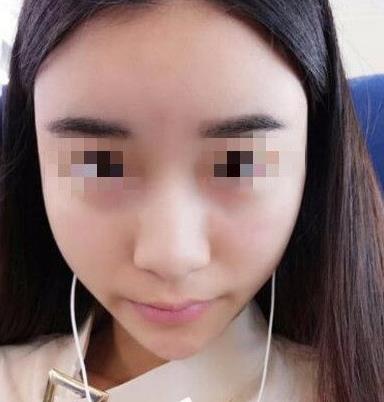 石家莊諾萬(wàn)整形姚華榮硅膠隆鼻案例分享術(shù)前效果