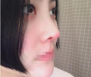 重慶星范整形超體隆鼻半個月效果