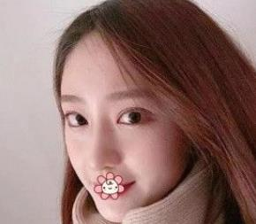 北京彤美耳軟骨隆鼻三個月效果分享，吐血推薦