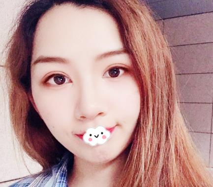 武漢伊萊美割雙眼皮怎么樣？切開雙眼皮恢復過程圖