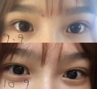 做雙眼皮案例，濟南坤如瑪麗崔金珍雙眼皮案例圖片