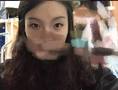 做雙眼皮案例，北京藝星張順慶雙眼皮案例圖片