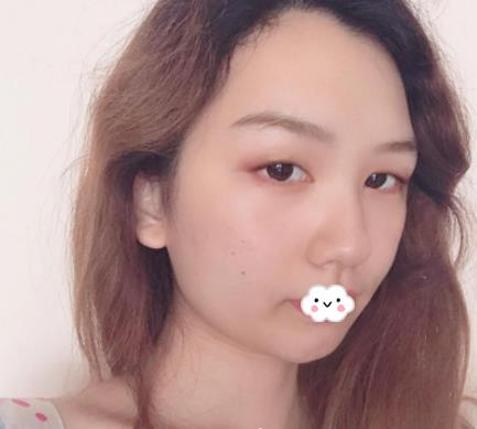 武漢伊萊美割雙眼皮怎么樣？切開雙眼皮恢復過程圖