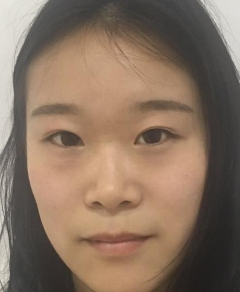 石家莊諾萬整形肋軟骨隆鼻案例分享，恢復(fù)過程圖