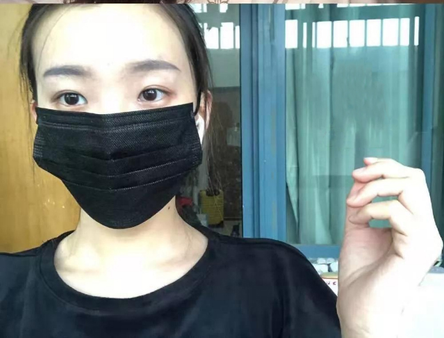 做雙眼皮案例，北京藝星張順慶雙眼皮案例圖片