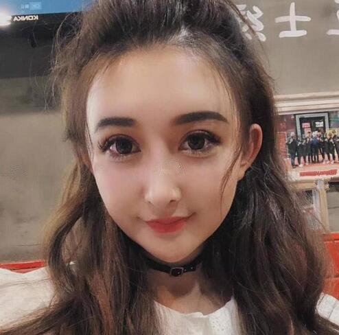 深圳陽光全臉填充后兩個月效果