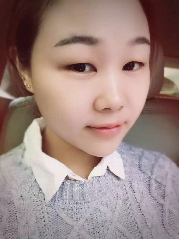腫眼泡應(yīng)該做哪種雙眼皮？汕頭曙光雙眼皮三個月效果分享