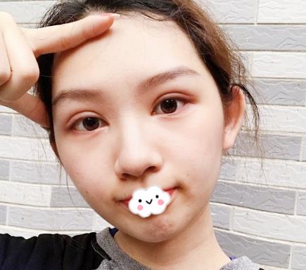 武漢伊萊美割雙眼皮案例分享術(shù)后一周效果